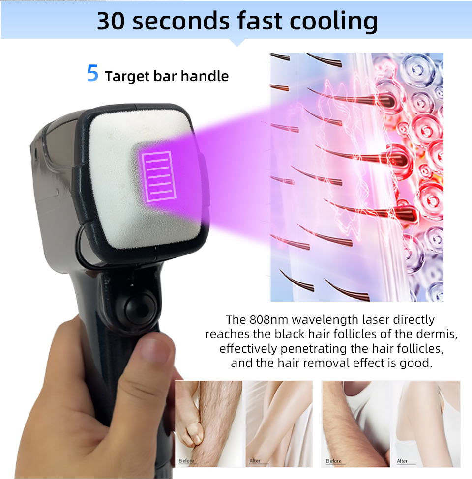 Neuer Stil Tragbarer 808 NM We – Industrial Laser Hair Removal Machine Bewertung und Preis